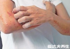 身上起红疙瘩很痒图片及原因，可能是湿疹