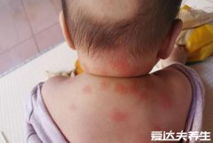 跳蚤咬过后的疙瘩照片,注意跳蚤很脏感染