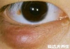 麦粒肿图片症状及治疗偏方，为形似麦粒的