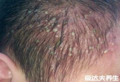 毛囊炎图片和初期症状，瘙痒疼痛的红色丘