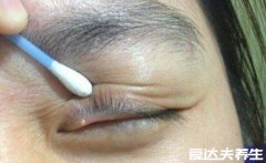 麦粒肿早期图片,眼睛长针眼的早期症状