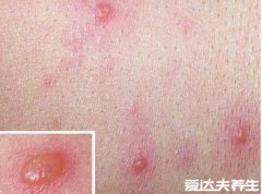 水痘刚开始的样子图片，从红点很快变成水