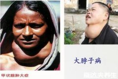 真实大脖子病图片,警惕早期症状颈部变粗