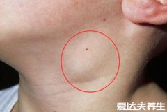 脖子淋巴癌早期症状图片,颈部或锁骨有不