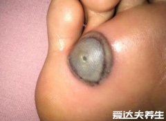 寻常疣图片及症状与治疗方法，多为坚硬小