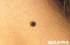 脖子上有痣代表什么,不仅有可能为桃花劫