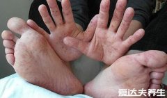 手足口病症状初期图片,出现感冒症状伴随