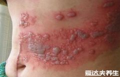 蛇盘疮图片大全,皮肤单侧红斑上长有簇集