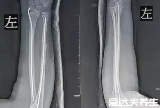 桡骨是哪个部位图片,位于手臂上端内侧与手腕相连(内尺外桡)