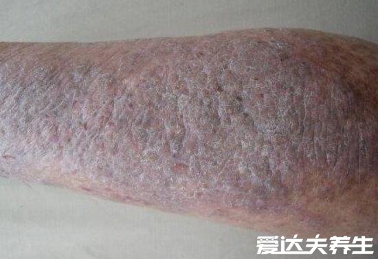 湿疹图片初期症状图片,有红斑状水泡瘙痒感强烈十分难受
