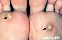 鸡眼挖出来的根图片，是淡黄色有针头至黄