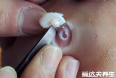 鸡眼挖出来的肉刺图，呈淡黄有倒圆锥状的