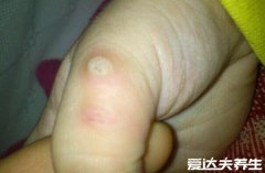 手和脚长鸡眼的图片，和跖疣很像千万别认