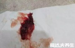 子宫内膜脱落真正图片,像血块有肉感为正