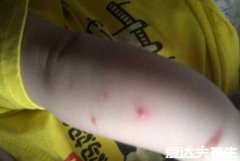 水痘的7天演变过程图片，护理方法得当一周