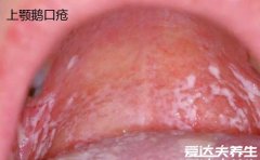婴儿鹅口疮最早期图片，口腔内有白色的乳