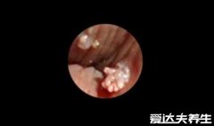 男女尖湿锐尤早期图片，私处出现淡红色的