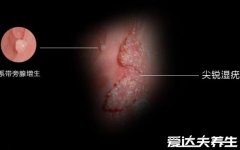 男性尖锐湿尤图初期图片，为菜花样小疙瘩