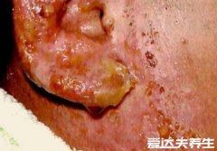 宝宝婴儿湿疹图片，多为密集针尖状小水泡