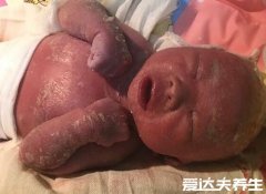 火棉胶婴儿长大后图片，有轻微的皮屑和正