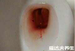 直肠癌早期的5大症状,突然大便变细且有便