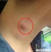 脖子淋巴癌早期症状图片，颈部淋巴肿大伴