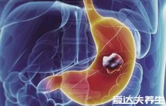 世界十大痛苦癌症排行榜,胃癌排第一不仅