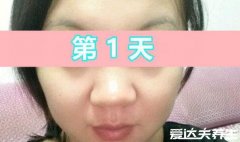 水痘的7天演变过程图片，从红色皮疹到水泡