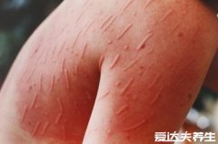 荨麻疹图片和症状，出现大小形状各异的风