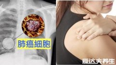 肺癌背疼位置图，不止背疼胳膊痛胸痛也是