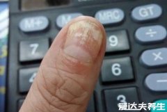 最轻微的灰指甲图片,难以根治尽量在早期