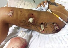 苯酚对人体有哪些危害,不仅腐蚀皮肤还有