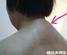 富贵包怎么形成的有什么危害,不正确姿势