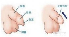 小儿包茎症状图片，不同程度包皮包茎的危