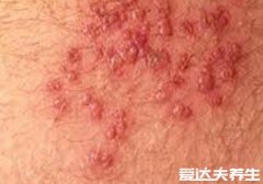 艾滋病初期小红点照片，与带症状疱疹十分
