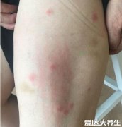 螨虫叮咬后的症状图,青春痘酒糟鼻皮疹多