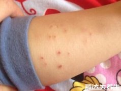 人身上被螨虫咬的图片,出现丘疹性荨麻疹