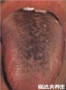 超详细胃癌早期舌头图片,舌苔发黑无知觉