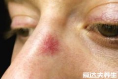 什么是蜘蛛痣,性激素代谢紊乱所引起的血
