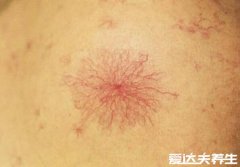 蜘蛛痣图片及症状,由于肝脏受损出现的血