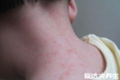 风疹图片及症状,属病毒性呼吸道传染病出