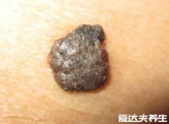 容易癌变的痣的图片,可根据4个特征来进行