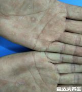 梅毒疹图片及症状,身上出现咖啡色皮疹并