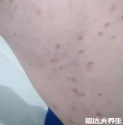 不同时期的艾滋病皮疹图片及症状,不痛不