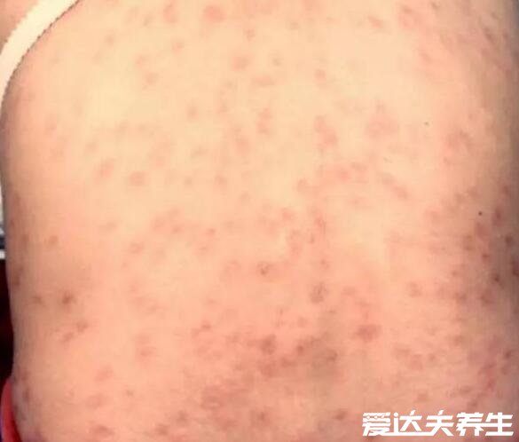 梅毒疹图片及症状,身上出现咖啡色皮疹并蔓延至全身
