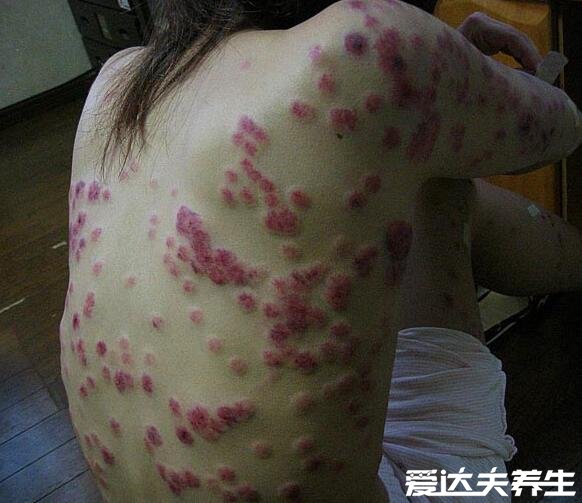 梅毒疹图片及症状,身上出现咖啡色皮疹并蔓延至全身
