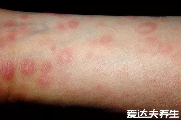 梅毒疹图片及症状,身上出现咖啡色皮疹并蔓延至全身