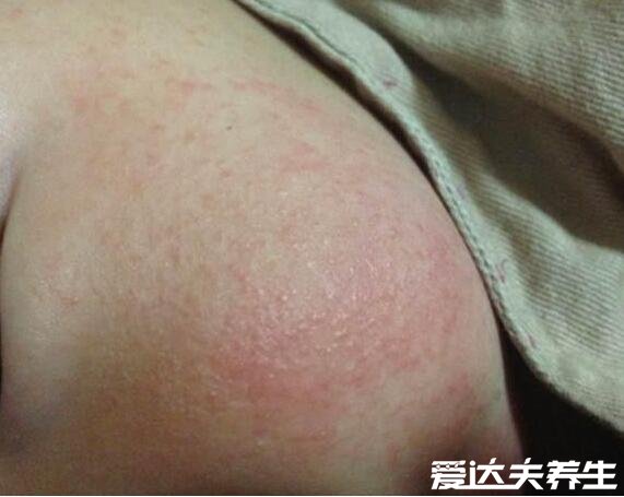 湿疹和热疹的区别图片,一眼就看出症状其实有明显不同