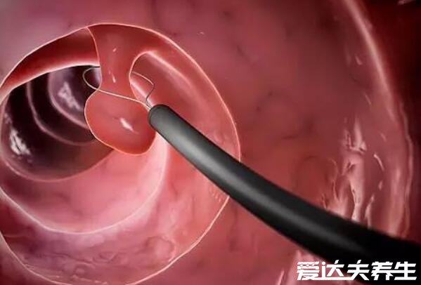 肠镜怎么做痛苦吗?时间多久,30分钟轻微腹胀感(因人而异)