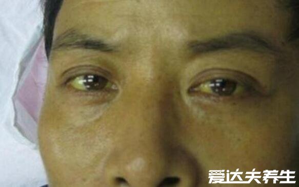 男性肝脏不好的4个表现,容易疲倦还会导致性欲下降